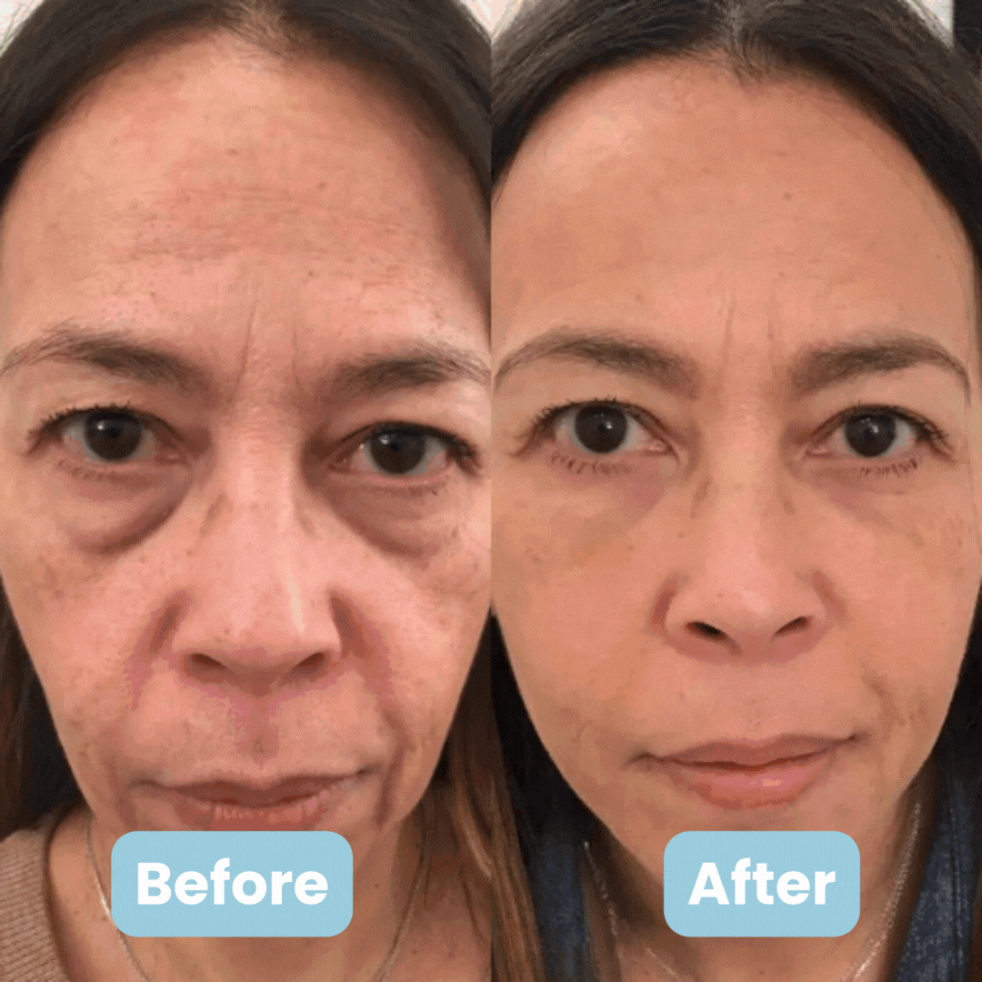 AuraESTHE 3'ü 1 arada LED Yüz Şekillendirici + 4 ÜCRETSİZ Hediye