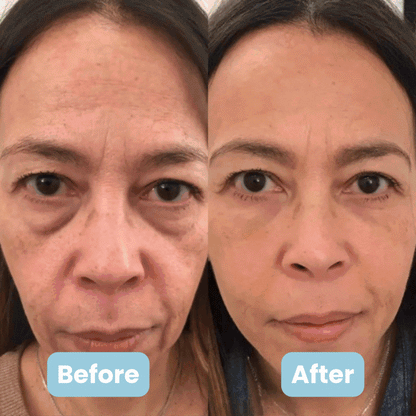 AuraESTHE 3'ü 1 arada LED Yüz Şekillendirici + 4 ÜCRETSİZ Hediye